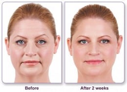 4 syringes of filler were used for the nasolabial folds and marionette lines